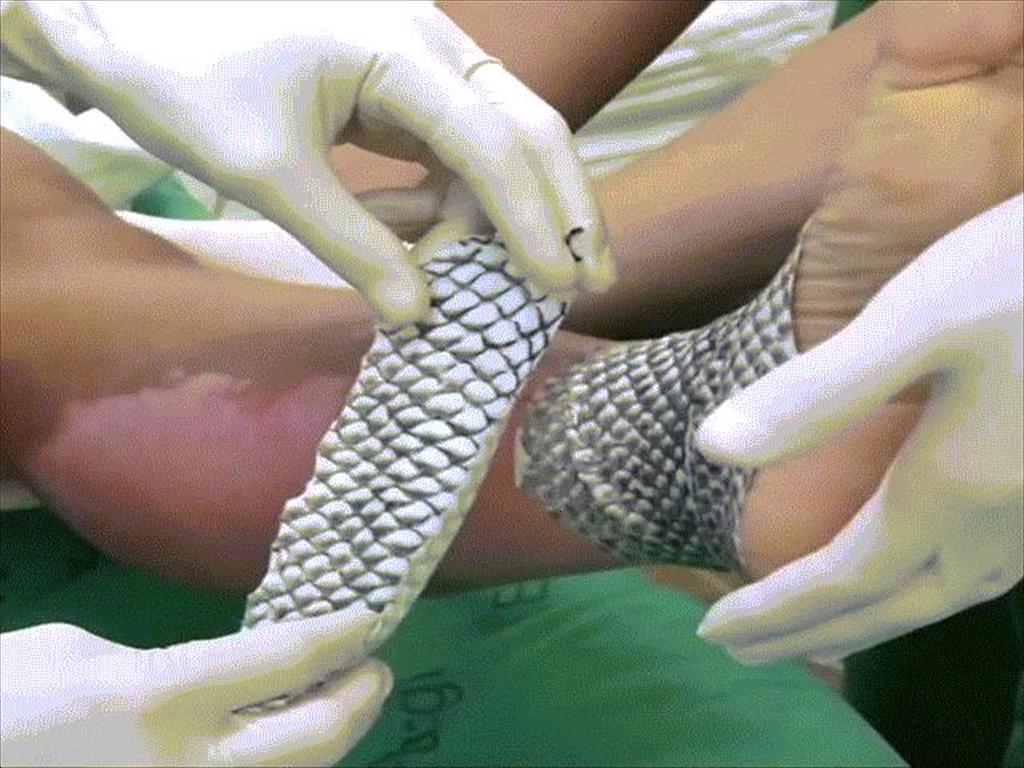 Brazil chuẩn bị xây dựng nhà máy đầu tiên trên thế giới sản xuất da cá rô phi trị bỏng